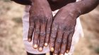 Namibia confirms first Mpox case